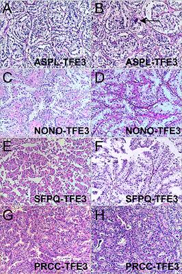 Clinical and pathological heterogeneity of four common fusion subtypes in Xp11.2 translocation renal cell carcinoma